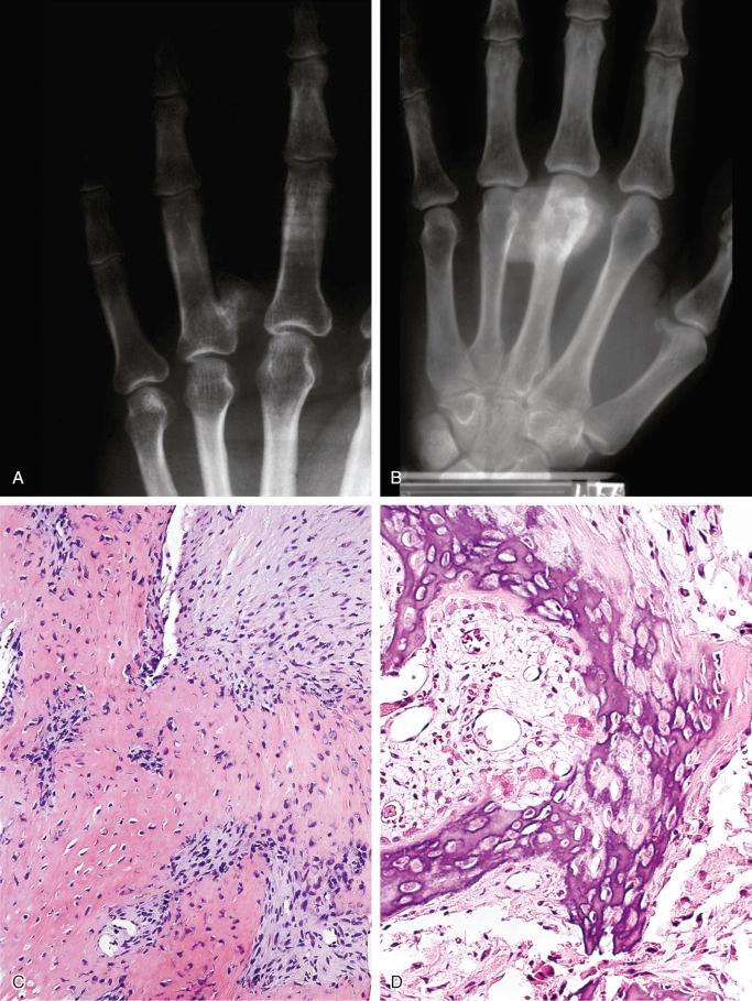 FIGURE 23-26, Bizarre parosteal osteocartilaginous proliferation (Nora's lesion): radiographic and microscopic features.