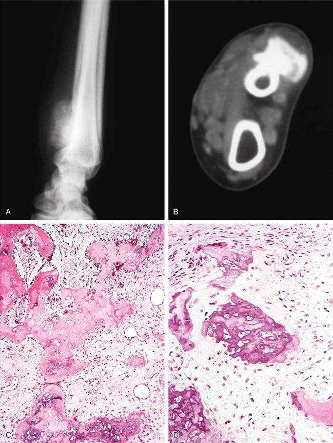 FIGURE 23-27, Bizarre parosteal osteochondromatous proliferation (Nora's lesion): radiographic and microscopic features.