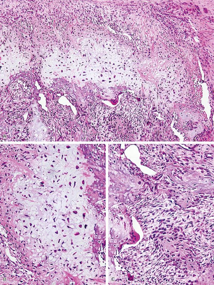 FIGURE 23-28, Bizarre parosteal osteochondromatous proliferation (Nora's lesion): microscopic features.