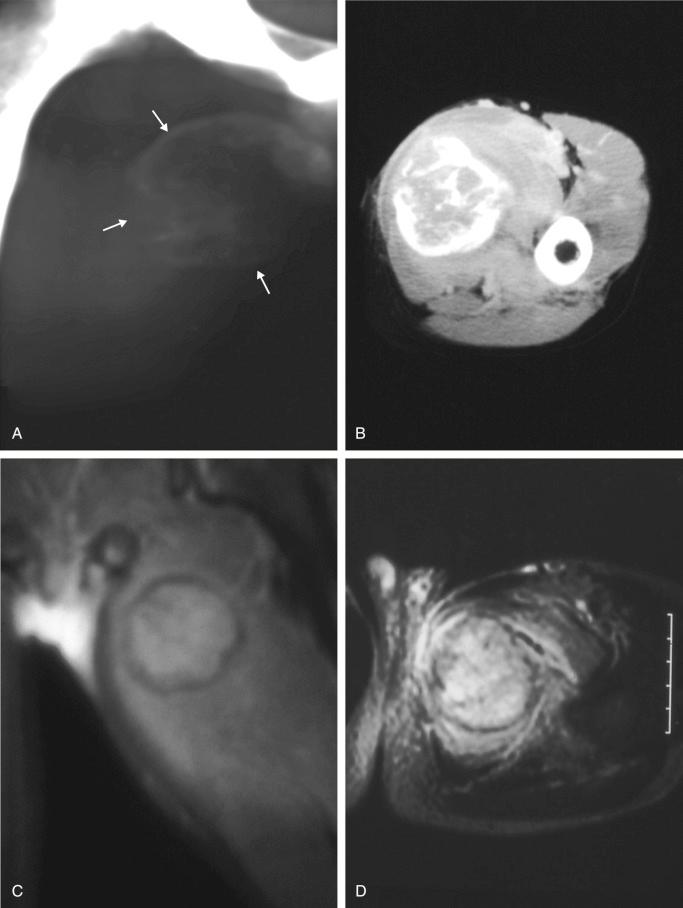 FIGURE 23-3, Myositis ossificans: radiographic features.