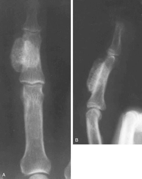 FIGURE 23-29, Acquired, posttraumatic exostosis (turret exostosis): radiographic features.