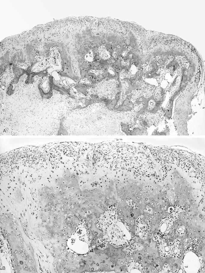 FIGURE 23-30, Acquired exostosis: microscopic features.