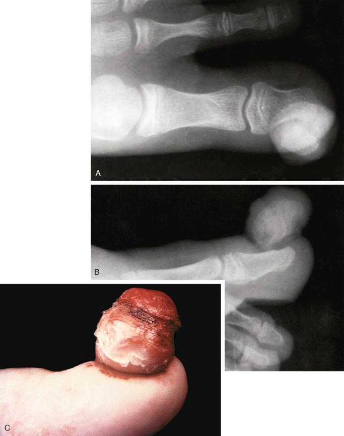 FIGURE 23-31, Subungual exostosis: radiographic features.