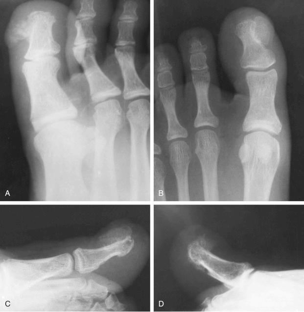 FIGURE 23-32, Subungual exostosis: radiographic features.