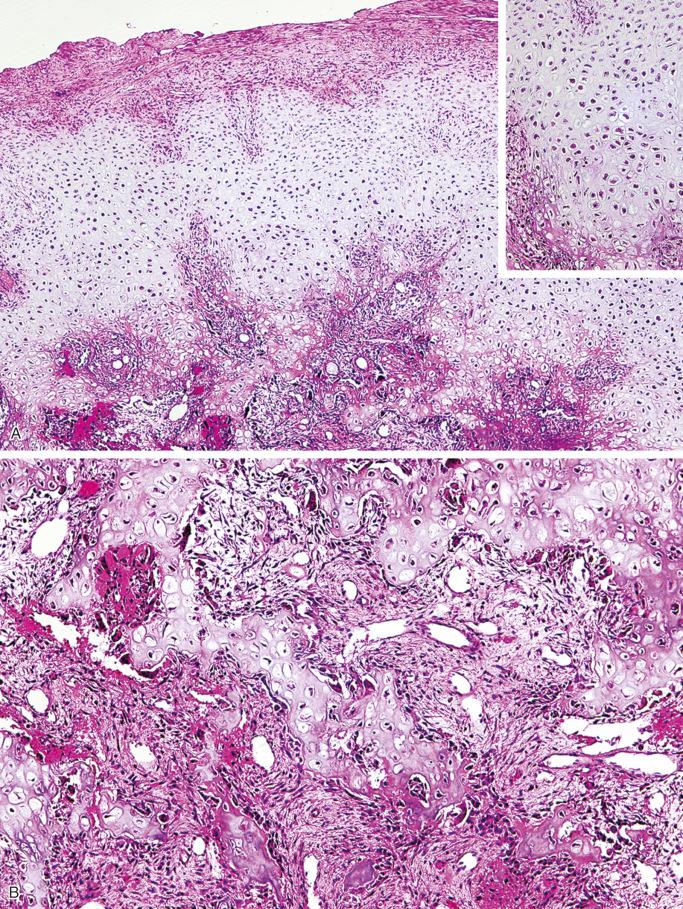 FIGURE 23-33, Subungual exostosis: microscopic features.