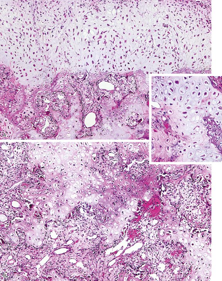 FIGURE 23-34, Subungual exostosis: microscopic features.