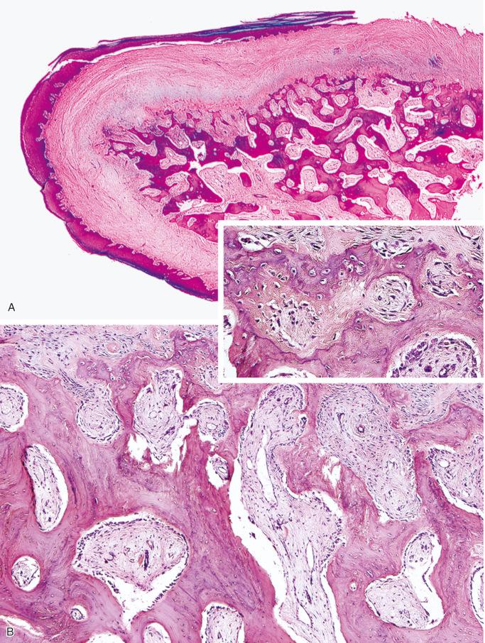 FIGURE 23-35, Subungual exostosis: microscopic features.