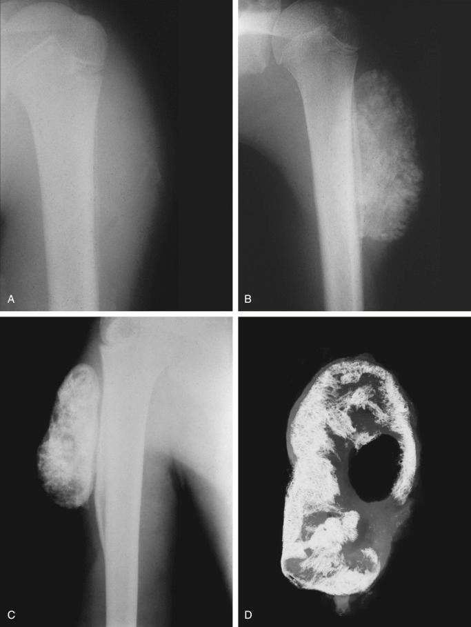 FIGURE 23-4, Myositis ossificans: radiographic features.