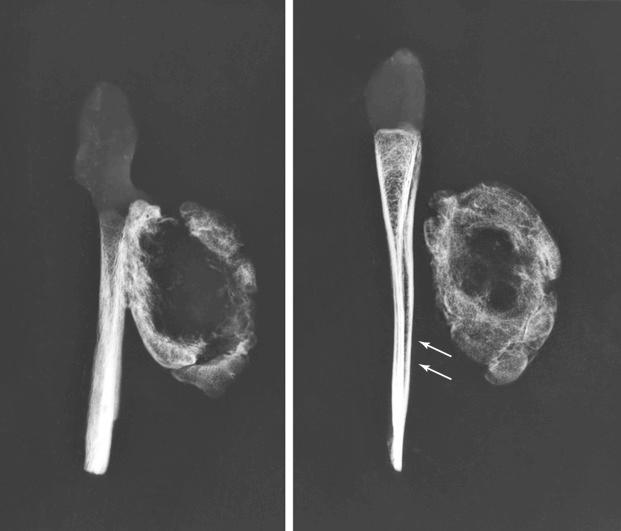 FIGURE 23-6, Parosteal myositis ossificans of scapula: specimen radiograph.