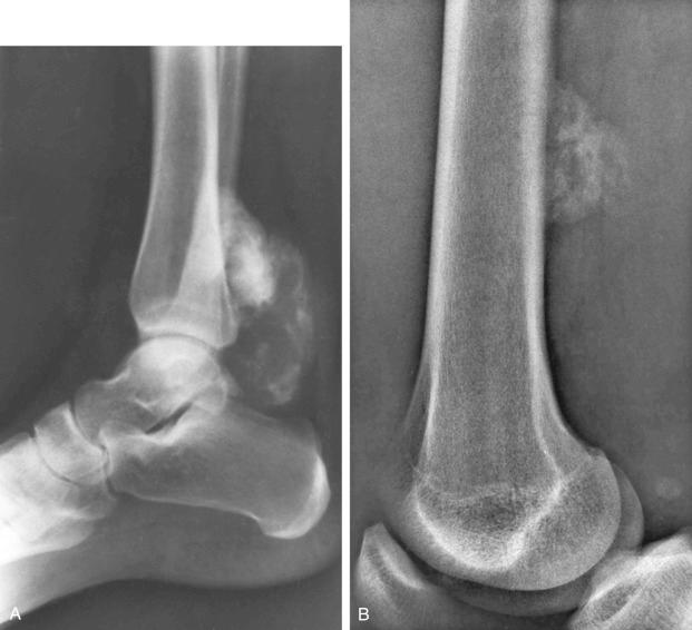 FIGURE 23-7, Parosteal myositis ossificans: radiographic features.