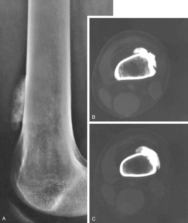FIGURE 23-8, Parosteal myositis ossificans: radiographic features.