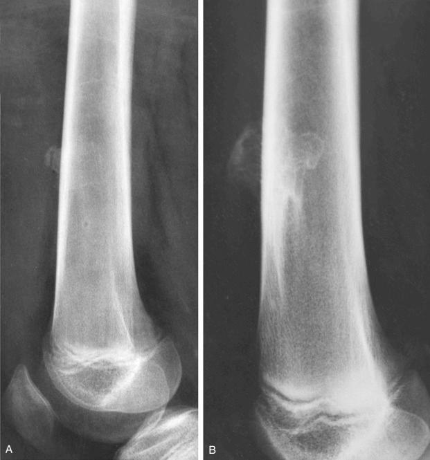 FIGURE 23-9, Parosteal myositis ossificans, late phase: radiographic features.