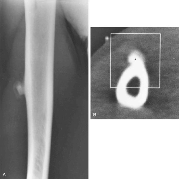 FIGURE 23-10, Parosteal myositis ossificans, late phase: radiographic features.