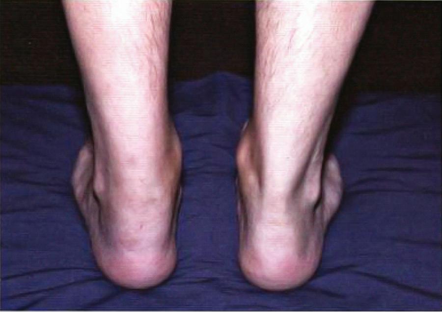 Fig. 182.1, Enthesitis—swelling of the posterior aspect of the left heel and lateral aspect of the ankle.