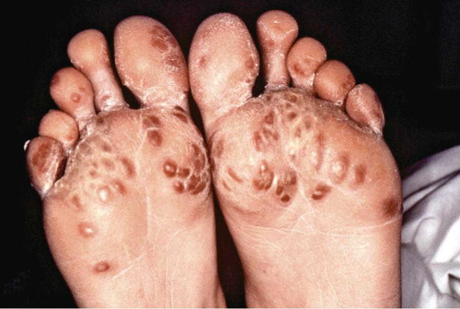 Fig. 182.2, Keratoderma blennorrhagica.