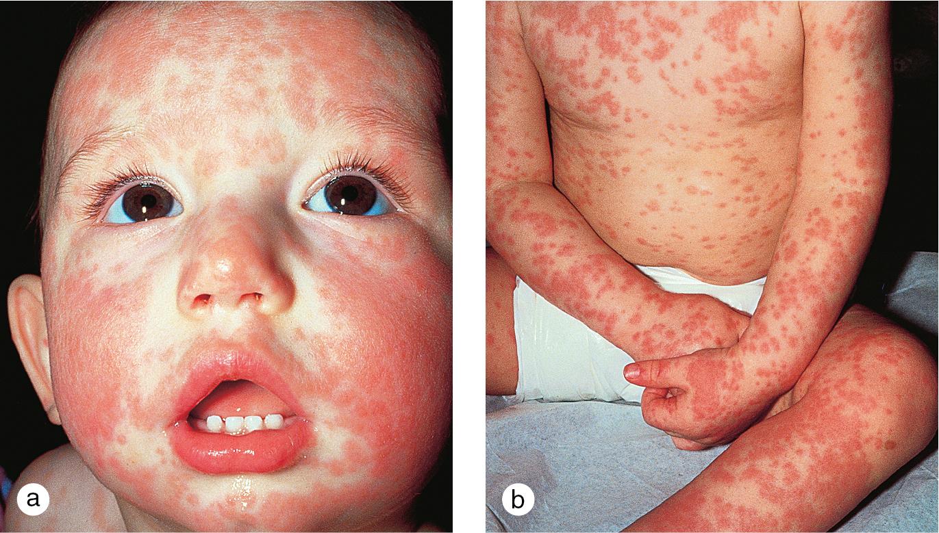 Fig. 7.1, A morbilliform reaction to phenobarbital developed in a toddler after 2 weeks of treatment for febrile seizures. Lesions were most prominent on (a) the face, and (b) the upper trunk and extremities. Note the perioral and perinasal sparing.