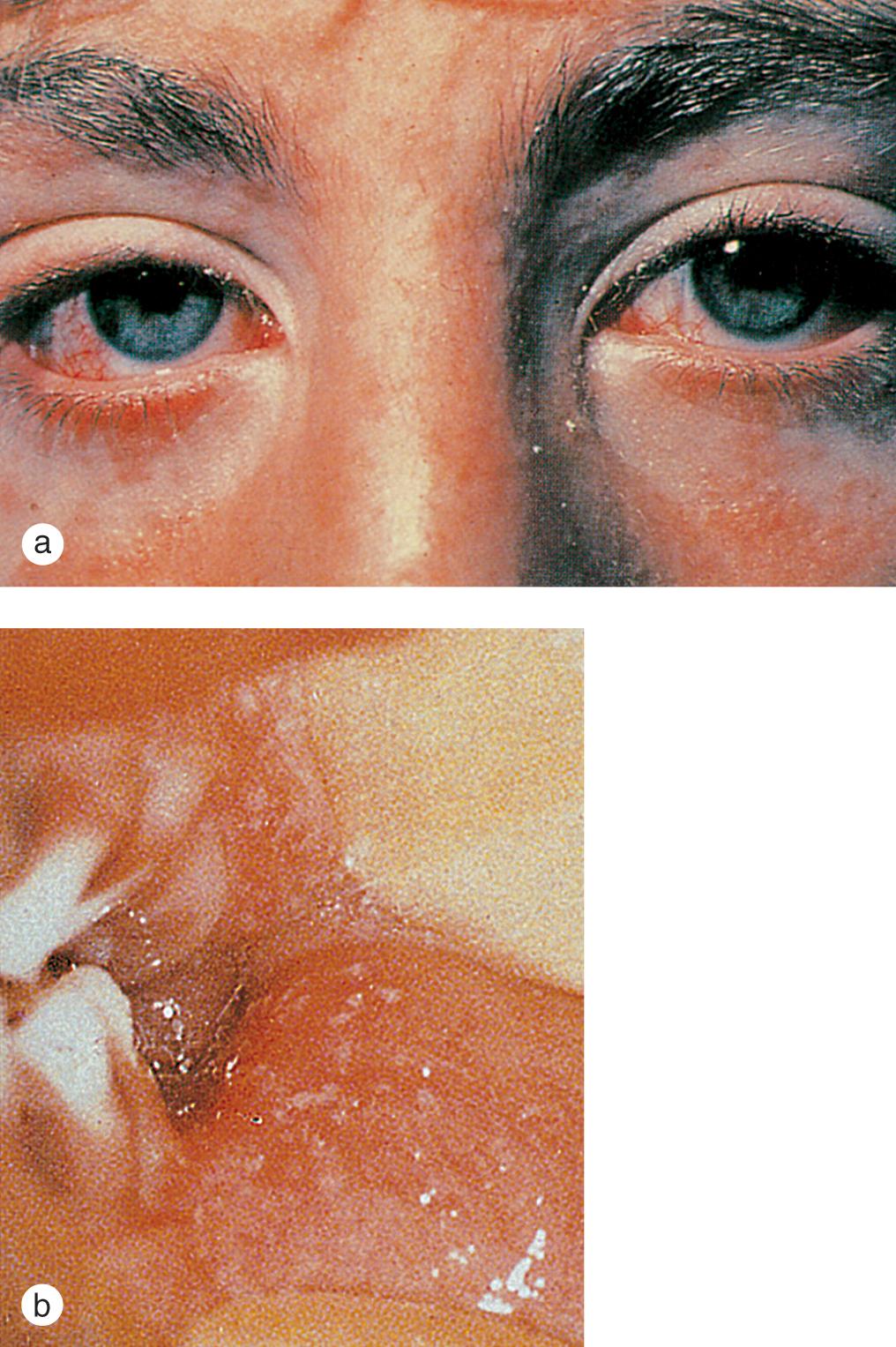 Fig. 7.11, Rubeola/measles. (a) During and after the prodromal period, the conjunctivae are injected and produce a clear discharge. This is associated with marked photophobia. (b) Koplik spots, bluish-white dots surrounded by red halos, appear on the buccal and labial mucosae a day or two before the exanthem and begin to fade with the onset of the rash.