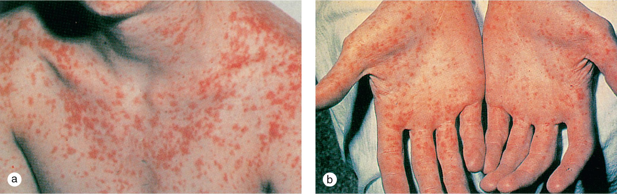 Fig. 7.12, The measles exanthem. (a) A blotchy, erythematous, blanching eruption appears at the hairline and spreads cephalocaudally over 3 days. (b) Ultimately, the exanthem involves the palms and soles. With evolution, lesions become confluent on the face, neck, and upper trunk.