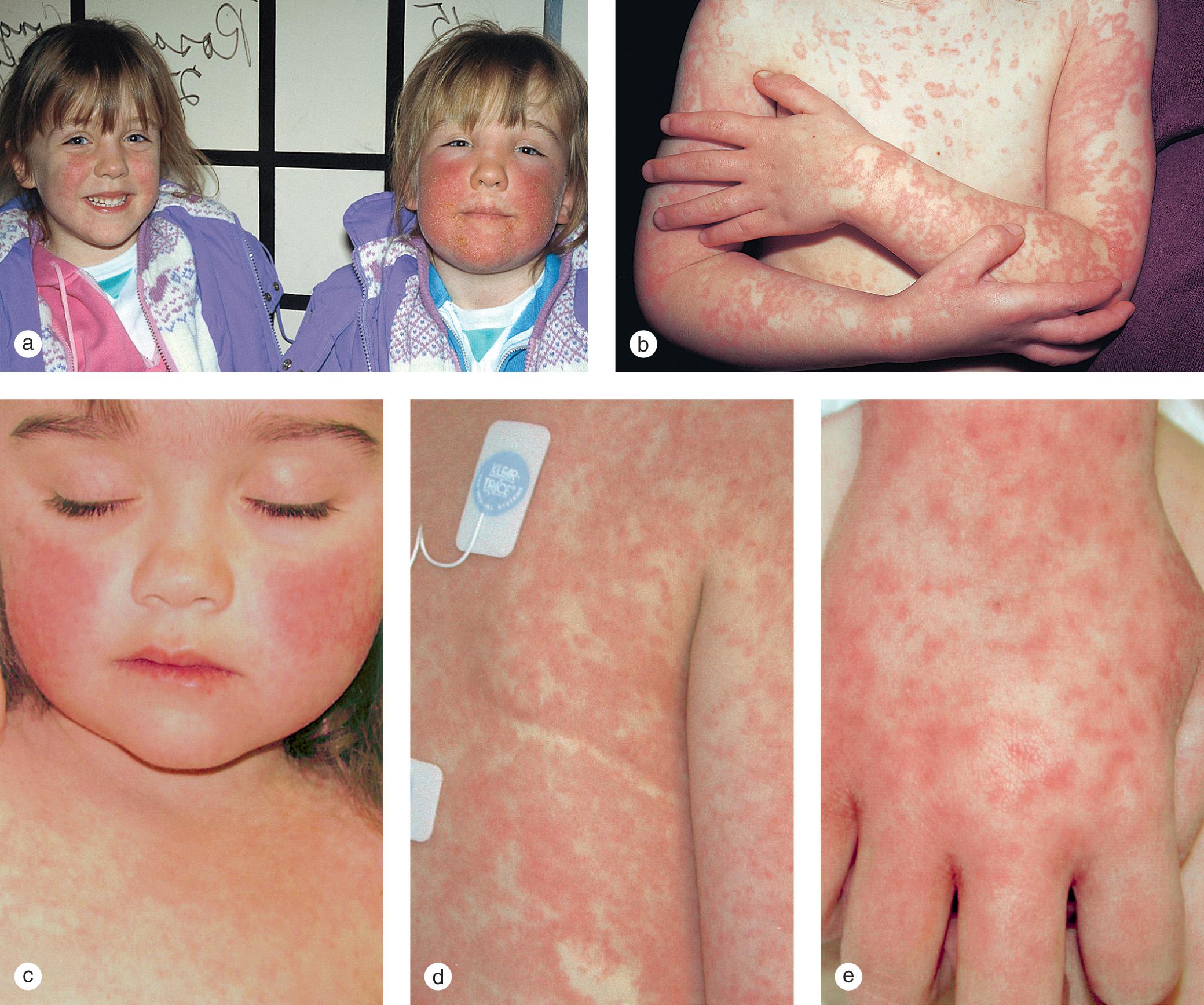 Fig. 7.13, Fifth disease. (a) These sisters demonstrate the slapped cheek erythema typical of erythema infectiosum. Despite the edema in one girl, both were completely asymptomatic. (b) A diffuse, lacy, and confluent annular eruption appeared on this otherwise healthy 9-year-old boy during a recent fifth disease epidemic. The reticulated erythema on his arms flared intermittently for 6 weeks. (c) Slapped cheek erythema and (d) a diffuse, reticulated, morbilliform eruption developed in this 4-year-old girl with high fever, arthralgias, and myalgias. (e) Four days into her illness she developed discrete and eventually confluent purpuric macules and papules on her hands and feet. Serology for parvovirus B19 was positive for acute infection.