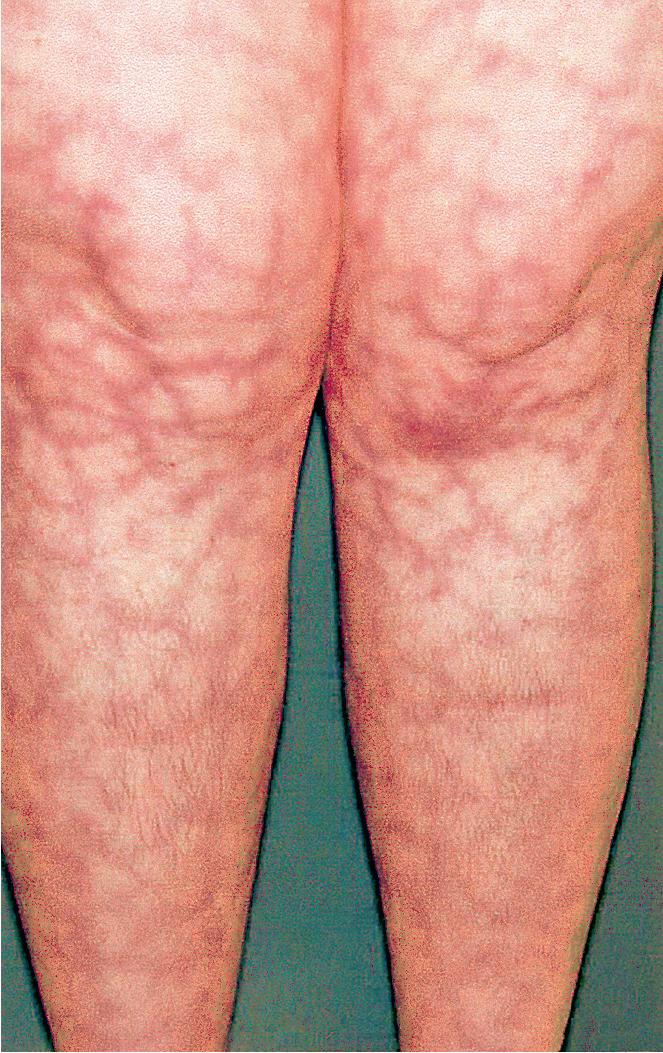 Fig. 7.14, Widespread livedo reticularis became particularly prominent on the extremities of this adolescent shortly after she started a neuroleptic medication for attention-deficit/hyperactivity disorder.