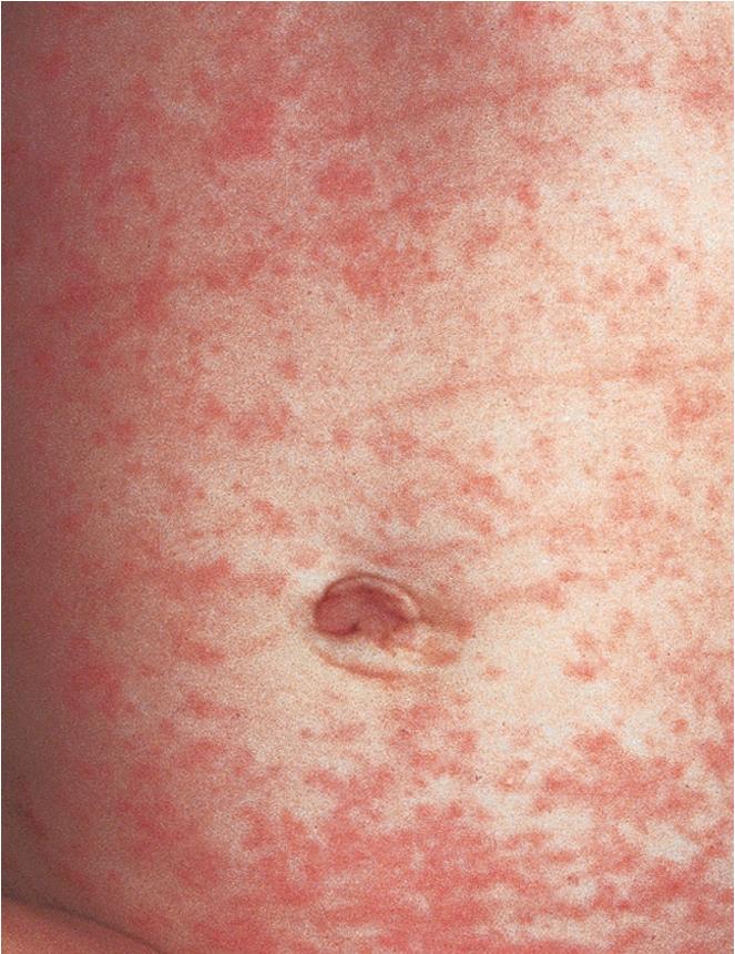 Fig. 7.15, Roseola/exanthema subitum. A generalized, pink, maculopapular rash suddenly appeared on this infant after 3 days of high fever.