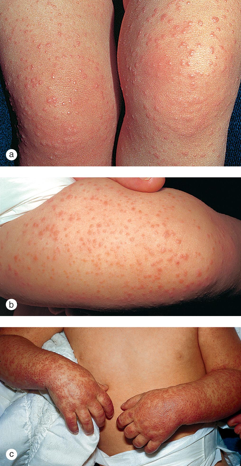 Fig. 7.16, Papular acrodermatitis. A symmetric, acrally distributed, red papular rash developed in this toddler with low-grade fever and loose stools. Note the discrete, edematous papules on the (a) knees and (b) thighs. (c) In some areas on his hands and forearms the lesions were confluent.