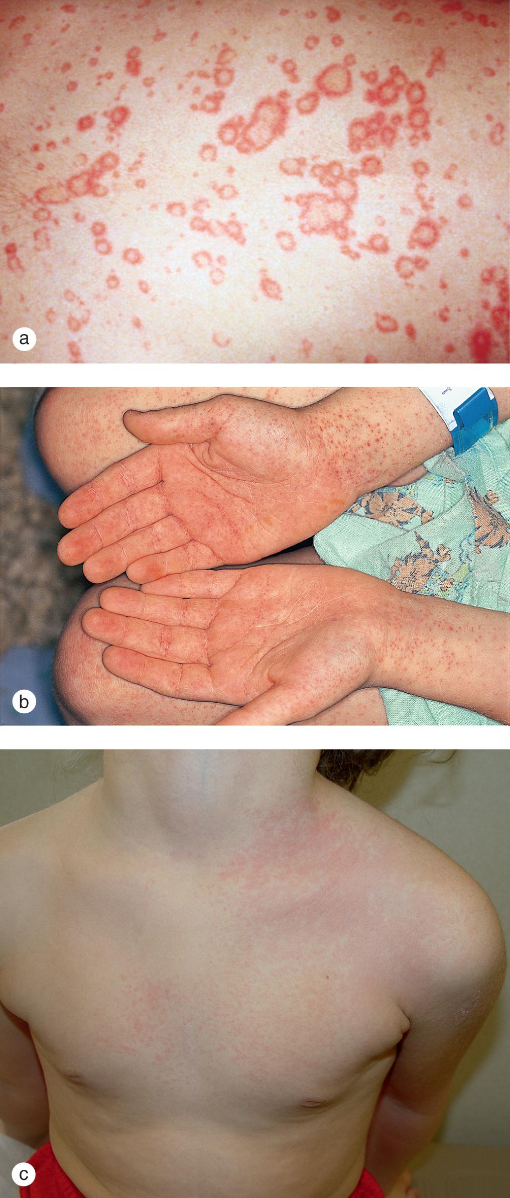 Fig. 7.17, (a) An urticarial viral exanthem spread from the trunk to the face and extremities in this infant. Lesions faded over several days. (b) A 6-year-old boy developed 1–2 mm red macules and petechiae on the distal extremities with involvement of the palms and soles. (c) This healthy 4-year-old boy developed a unilateral discrete and confluent papular eruption on his left chest, which generalized over several days.