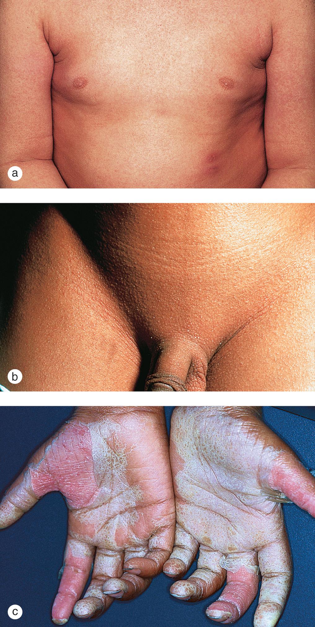 Fig. 7.18, Scarlet fever. (a) A generalized, bright red, sandpaper-like papular rash developed in a 7-year-old boy with a streptococcal pharyngitis. Note the accentuation of the rash at the neck and axillary and antecubital creases. (b) A 5-year-old boy demonstrated a similar eruption with Pastia lines in the groin creases. (c) Widespread desquamation appeared in this 8-year-old girl 10 days after the onset of symptoms and rash and was most prominent on the hands and feet.