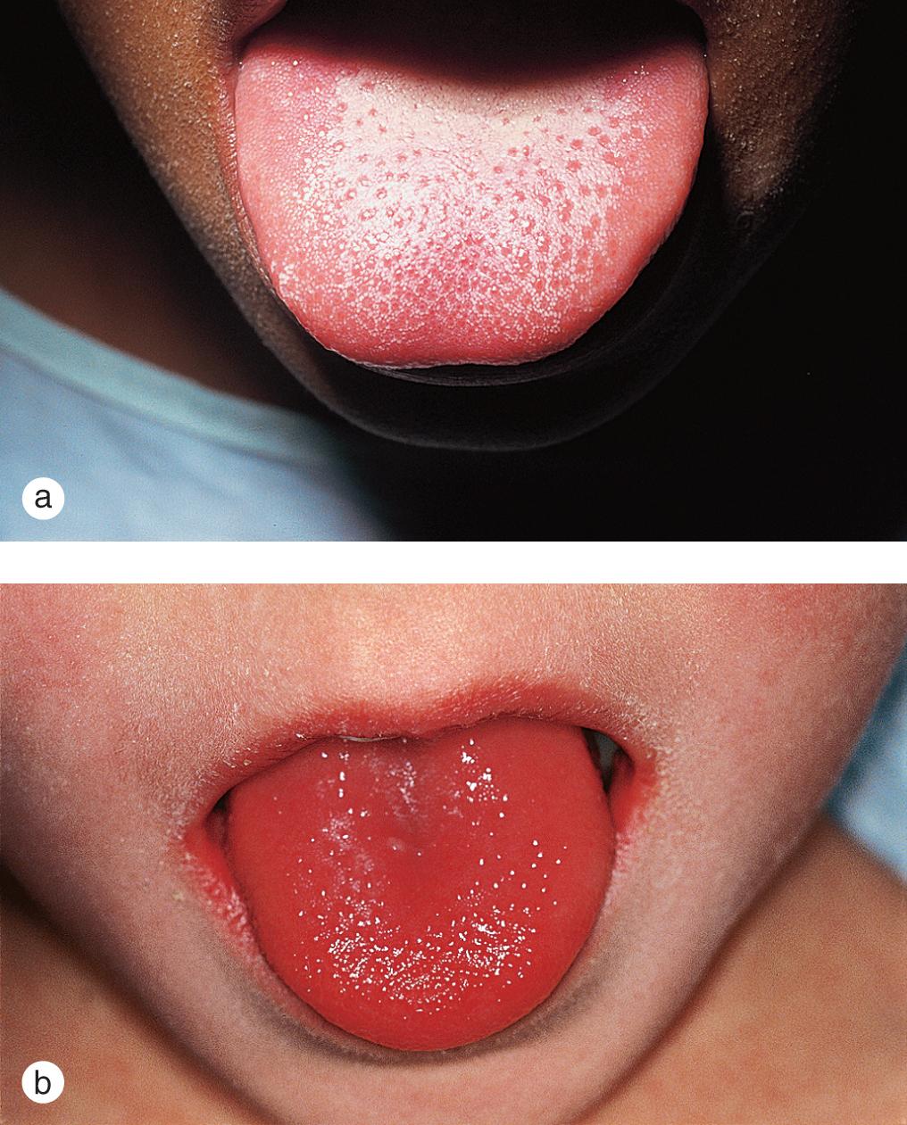 Fig. 7.19, Scarlet fever. (a) A white strawberry tongue is usually followed by (b) a red strawberry tongue as the erythrotoxin-mediated enanthema evolves.