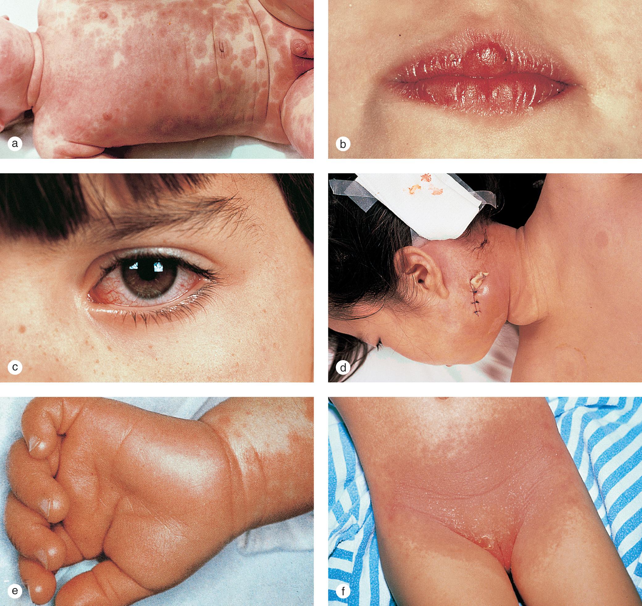 Fig. 7.20, Kawasaki syndrome. Characteristic clinical findings demonstrated include (a) a generalized, morbilliform, erythema multiforme-like rash, (b) erythema and fissuring of the lips, (c) conjunctival injection, (d) lymphadenopathy, (e) palmar and plantar erythema with edema of the hands and feet, and (f) erythema and scaling in the groin creases.