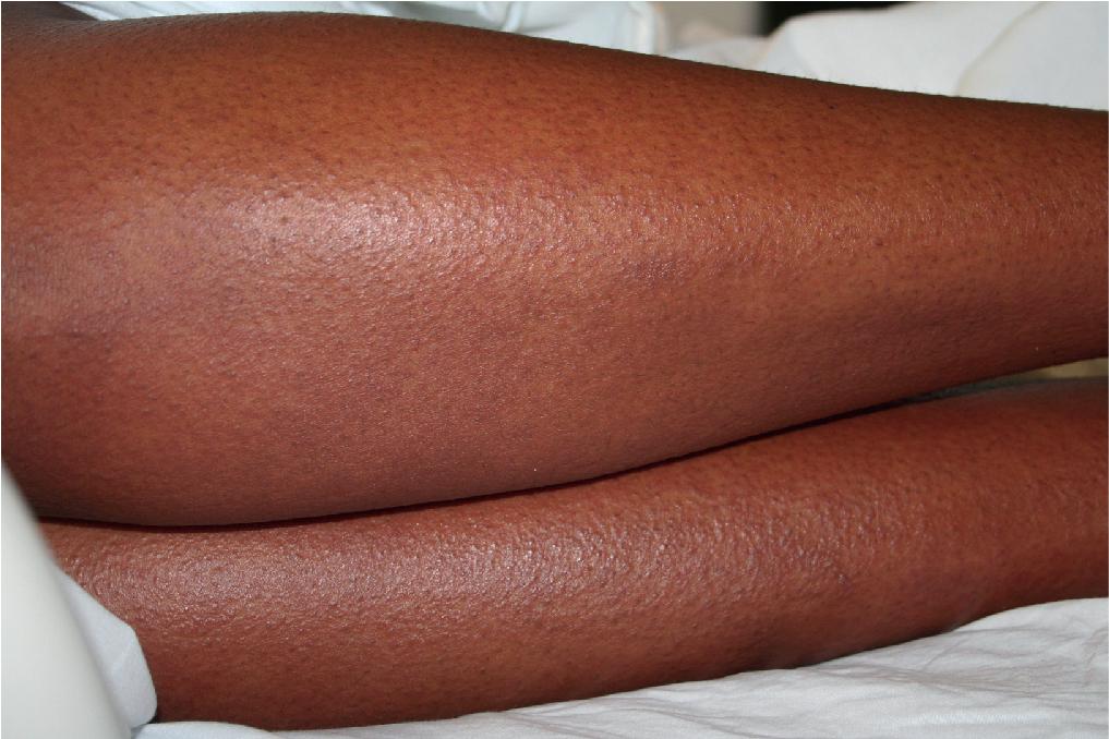 Fig. 7.2, DRESS. This adolescent developed high fever, hepatitis, generalized edema, and a progressive diffuse erythema with follicular prominence on her extremities after treatment of acne with oral trimethoprim-sulfamethoxazole tablets.