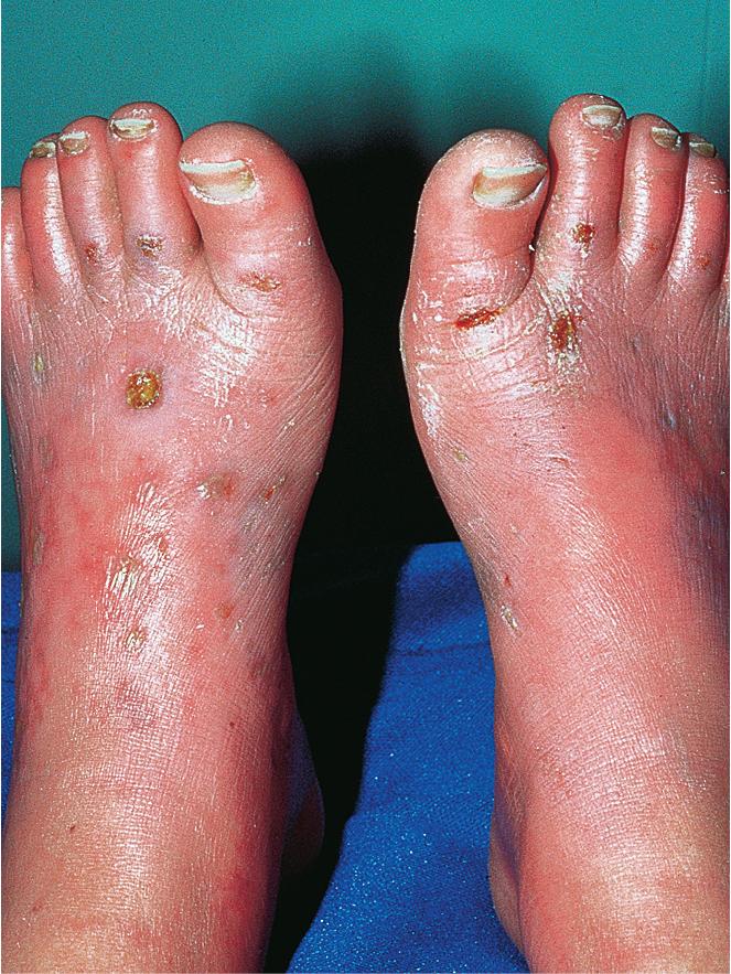 Fig. 7.21, Erythromelalgia. Necrotic blisters and ulcerations recurred chronically in this 11-year-old girl, who received relief from throbbing, debilitating foot pain by dunking her feet in near-freezing water for up to 12 h a day. Her brother also had erythromelalgia, but his symptoms were mild and usually resolved with leg elevation alone.