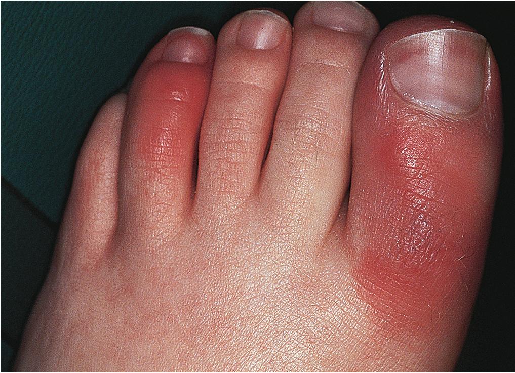 Fig. 7.22, Pernio. Painful, purple nodules developed on the sides of the feet and toes in this 13-year-old boy after walking with wet boots in a cold stream.