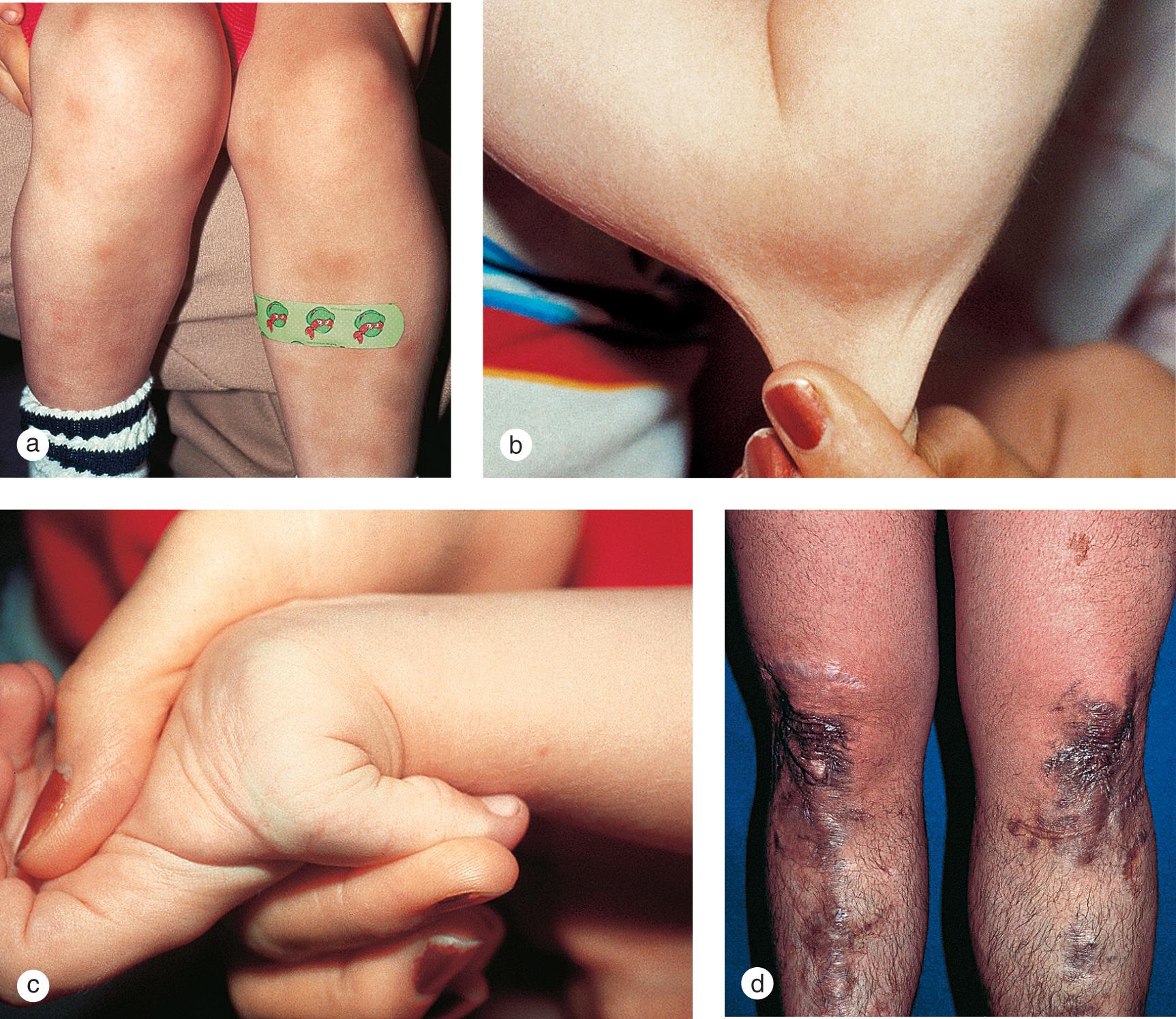 Fig. 7.23, Ehlers–Danlos syndrome. This child demonstrates a number of classic features of the disorder, which include (a) increased bruisability, (b) hyperelastic skin, and (c) hyperextensible joints. His father (d) had multiple, wide, atrophic purple scars over the shins, which accumulated over the years from trauma.