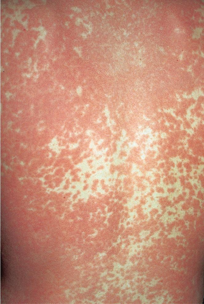 Fig. 7.3, A teenager who was initially diagnosed with streptococcal pharyngitis was started on ampicillin. After 4 days, a morbilliform rash erupted on the trunk and spread to the face and extremities. A monospot test was positive in the office, and the antibiotic was discontinued.