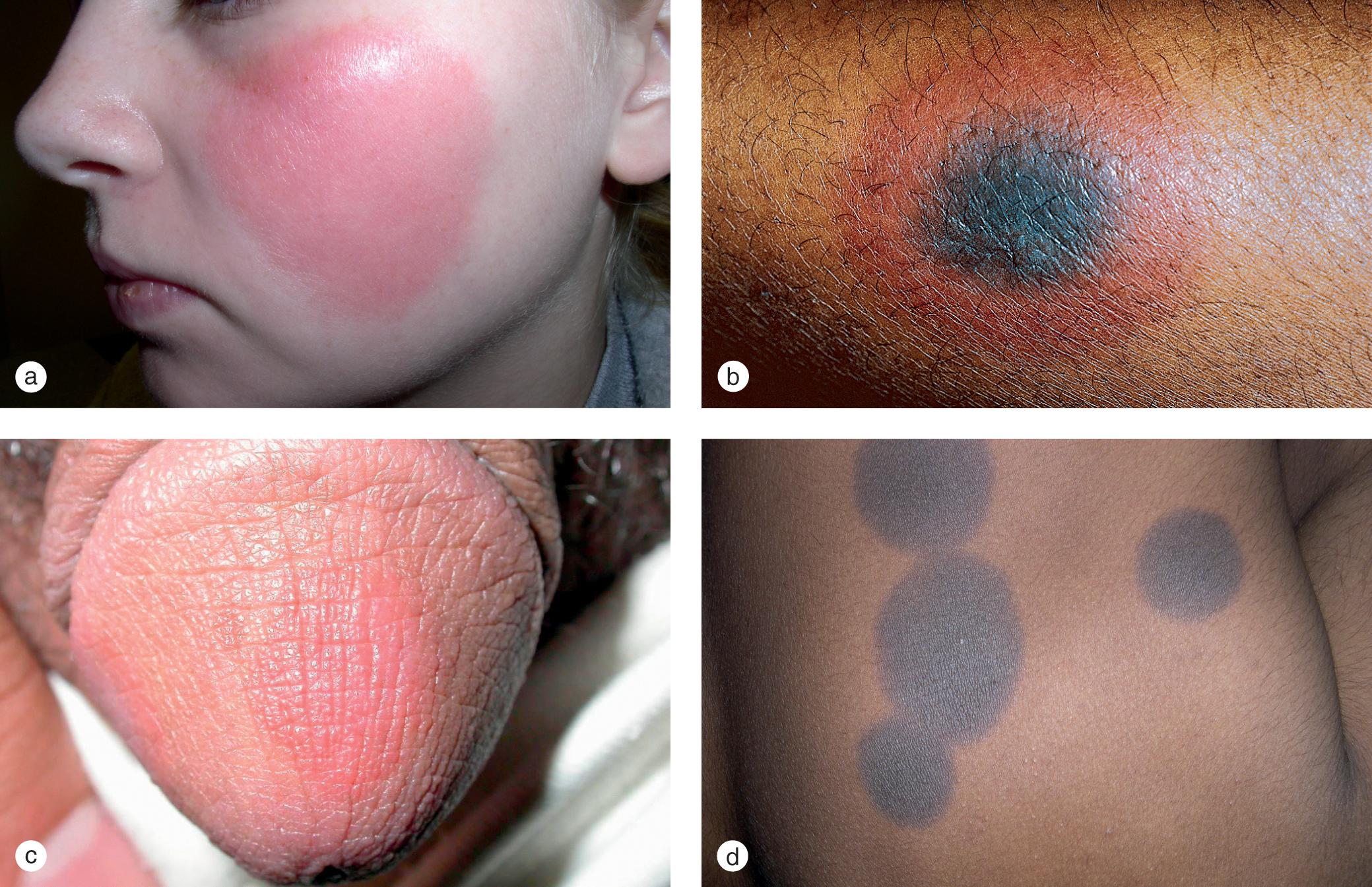 Fig. 7.4, Fixed drug eruption. (a) This adolescent girl developed a recurrent fixed drug reaction whenever she took a non-steroidal anti-inflammatory drug for menstrual cramps. (b) This 10-year-old, darkly pigmented boy developed a recurrent target lesion in the same spot on his arm after exposure to a cold remedy. Note the dusky center with marked hyperpigmentation. (c) Typical itchy violaceous plaques developed on the glans penis of this adolescent boy when he was started on doxycycline for treatment of acne. (d) Dramatic hyperpigmented macules persisted after a fixed drug eruption to an oral antibiotic resolved.