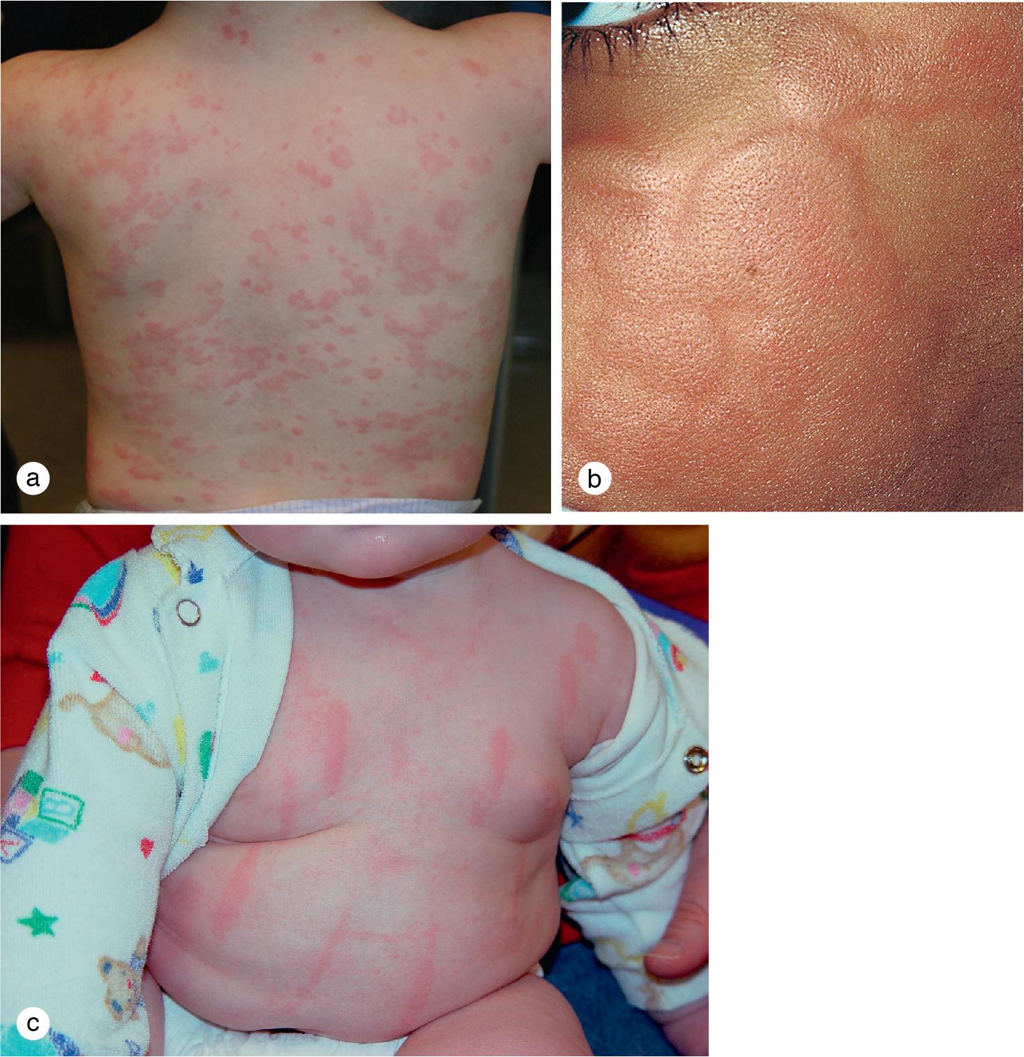 Fig. 7.5, Urticaria. (a) Pruritic papules and annular plaques recurred on the trunk and extremities of a toddler with chronic urticarial. (b) Wheals have become confluent on the face of this boy. (c) This infant developed recurrent urticaria and dermatographism, demonstrated here by vertical linear red plaques with surrounding pallor.