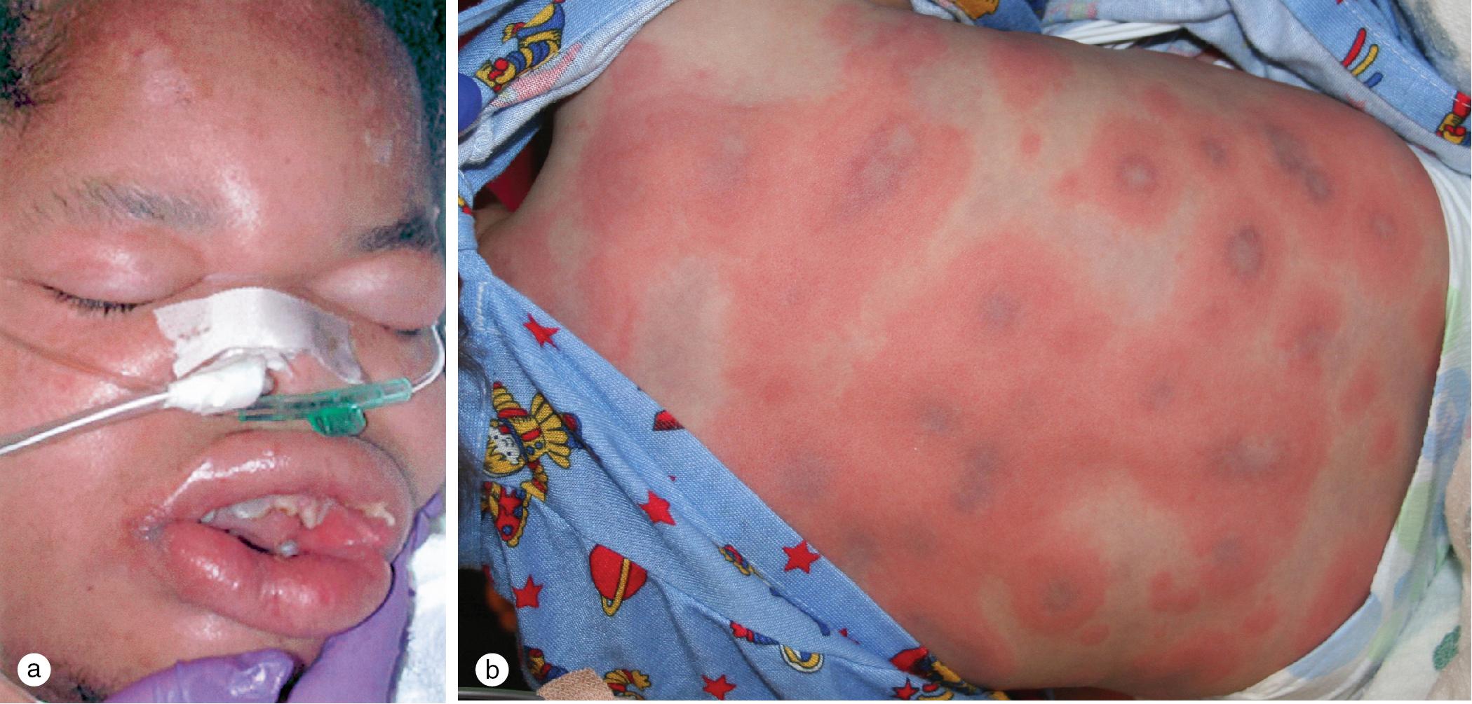 Fig. 7.6, (a) This 12-year-old boy developed diffuse angioedema with some airway involvement shortly after receiving intramuscular penicillin after a dental procedure. (b) Generalized migratory itchy papules and annular plaques with central purpura typical of urticarial multiforme developed on this 3-year-old girl with viral gastroenteritis.