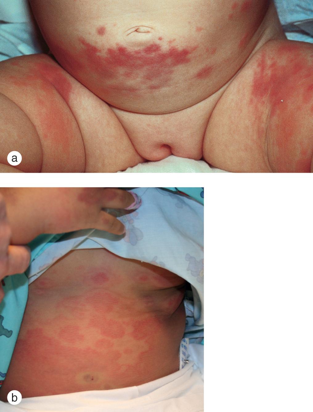 Fig. 7.7, (a) A 10-month-old girl developed urticaria on the lower trunk and thighs while being treated with cefaclor for an ear infection. Although the drug was stopped, the annular plaques progressed and became purpuric centrally. The rash was accompanied by arthralgias, joint swelling, and fever consistent with a serum sickness picture. (b) Generalized migratory itchy papules and plaques (urticaria multiforme) developed in this 4-year-old girl with a viral gastroenteritis.