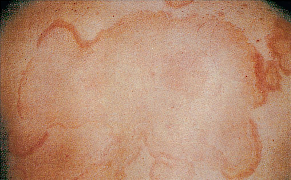 Fig. 7.8, Erythema marginatum in a child with acute rheumatic fever. Note the scalloped margins and distribution on the trunk.