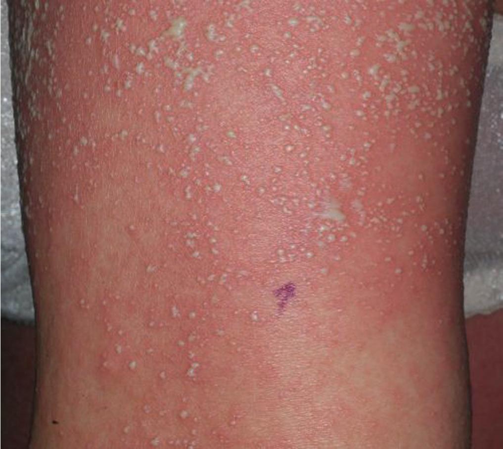Fig. 7.9, This patient developed a generalized red papular eruption with central pustules while on an antibiotic for pharyngitis.