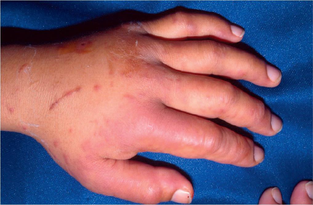 Fig. 7.10, This young adult developed painful indurated red confluent plaques on the palms and soles after infusion of bleomycin.