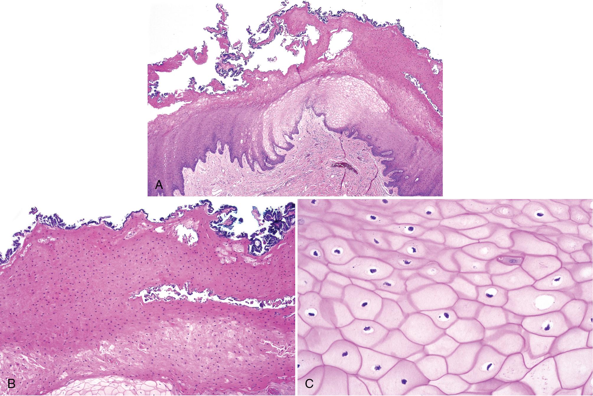 FIG. 10.9, Chronic frictional/factitial keratosis. (A) Marked shaggy parakeratosis with fissures and clefts rimmed by bacteria, and acanthosis. (B) Marked parakeratosis with bacterial colonization and no inflammation. (C) Prominent keratinocyte edema.