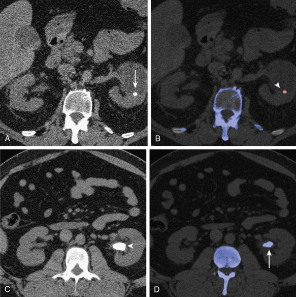 Figure 7-2, A, Axial unenhanced abdominal computed tomography (CT) scan in a 43-year-old man shows a calculus in the left midpole (arrow). B, Corresponding color-coded dual-energy postprocessed image shows the calculus coded as red (arrowhead) indicating a uric acid stone. C, Axial unenhanced abdominal CT scan in a 36-year-old man shows a large calculus in the left renal pelvis (arrow). D, Corresponding color-coded dual-energy image after postprocessing shows the calculus coded as blue (arrowhead), indicating a non–uric acid stone.
