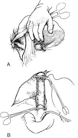 FIGURE 45-11