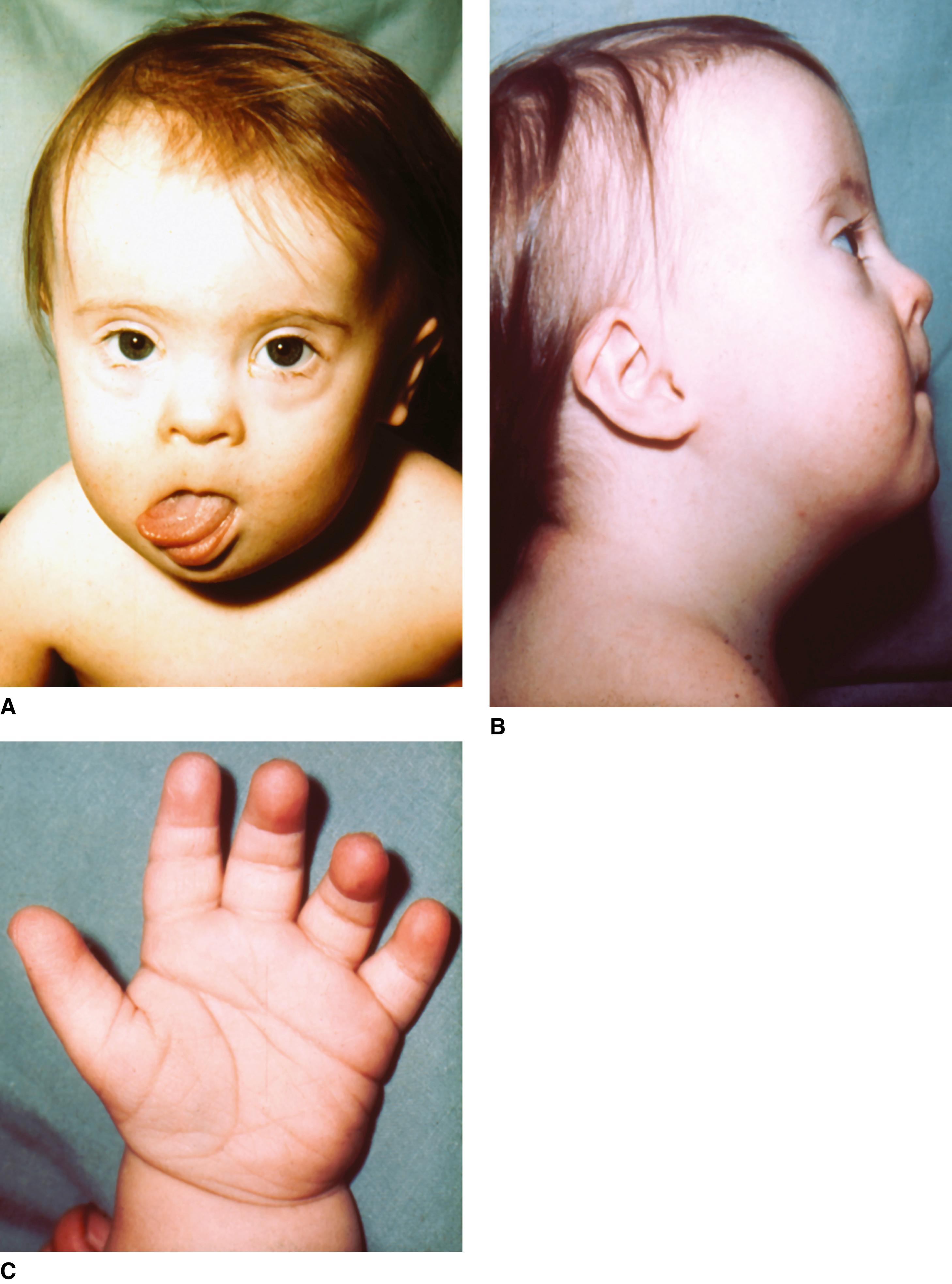 FIGURE 1, Down syndrome.