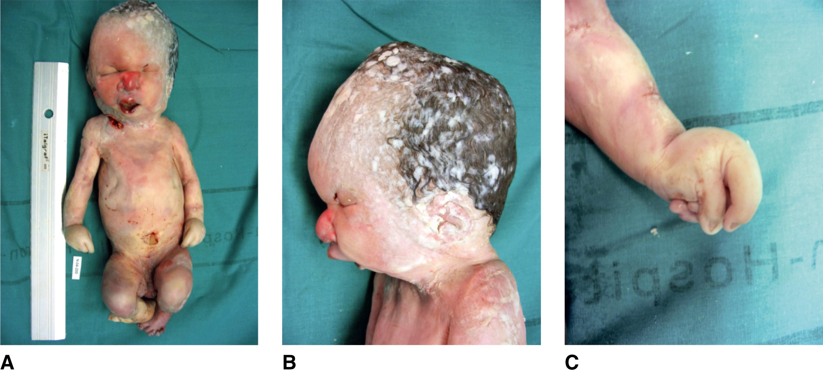 FIGURE 2, A, Stillborn at term with mosaic trisomy 9. Note growth retardation as well as multiple contractures with extended elbows, flexed hips and knees. A and B, Facial features include short palpebral fissures, deeply set eyes; prominent nasal bridge with short root, small fleshy tip, and slit-like nostrils; prominent lip covering receding lower lip; micrognathia, low-set, posteriorly rotated, and misshapen ears. C, Note extended wrist with clenched hands and hypoplastic nails.