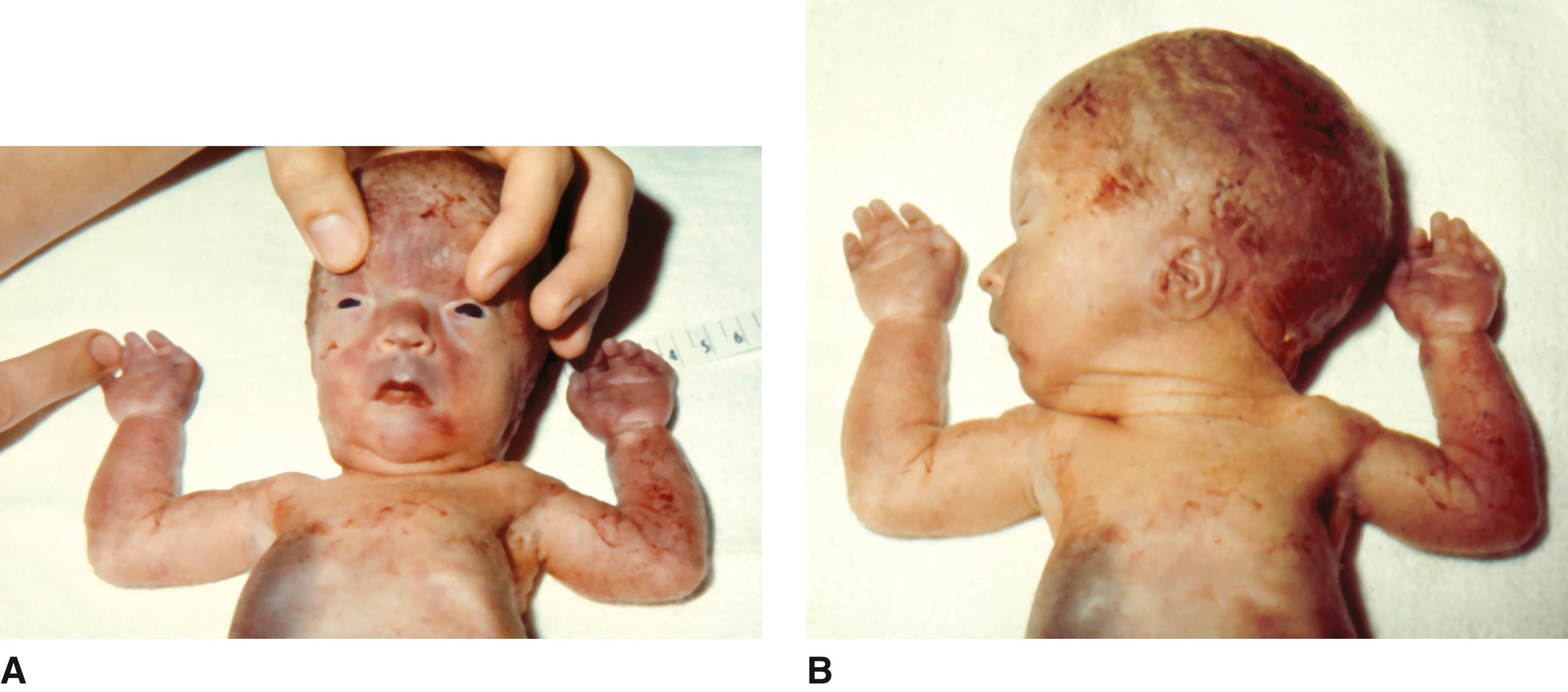 FIGURE 1, A and B, Stillborn infant with triploidy showing relatively large-appearing upper head in relation to very small face and 3-4 syndactyly of the fingers.