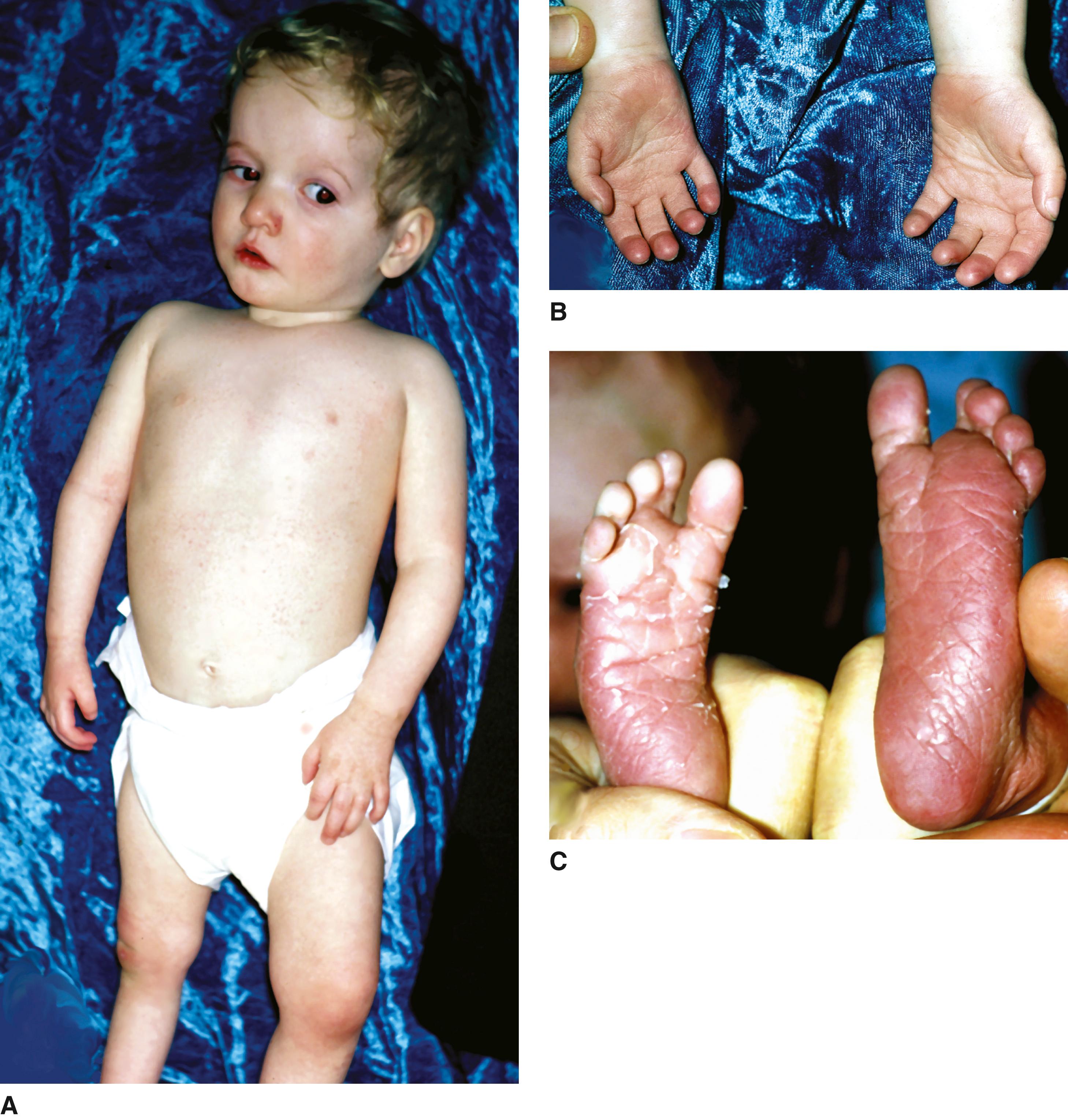 FIGURE 3, A–C, Infant with asymmetric growth deficiency (right side smaller), syndactyly of third and fourth fingers, and mild developmental delay who has triploid/diploid mixoploidy syndrome that is evident only in cultured fibroblasts.