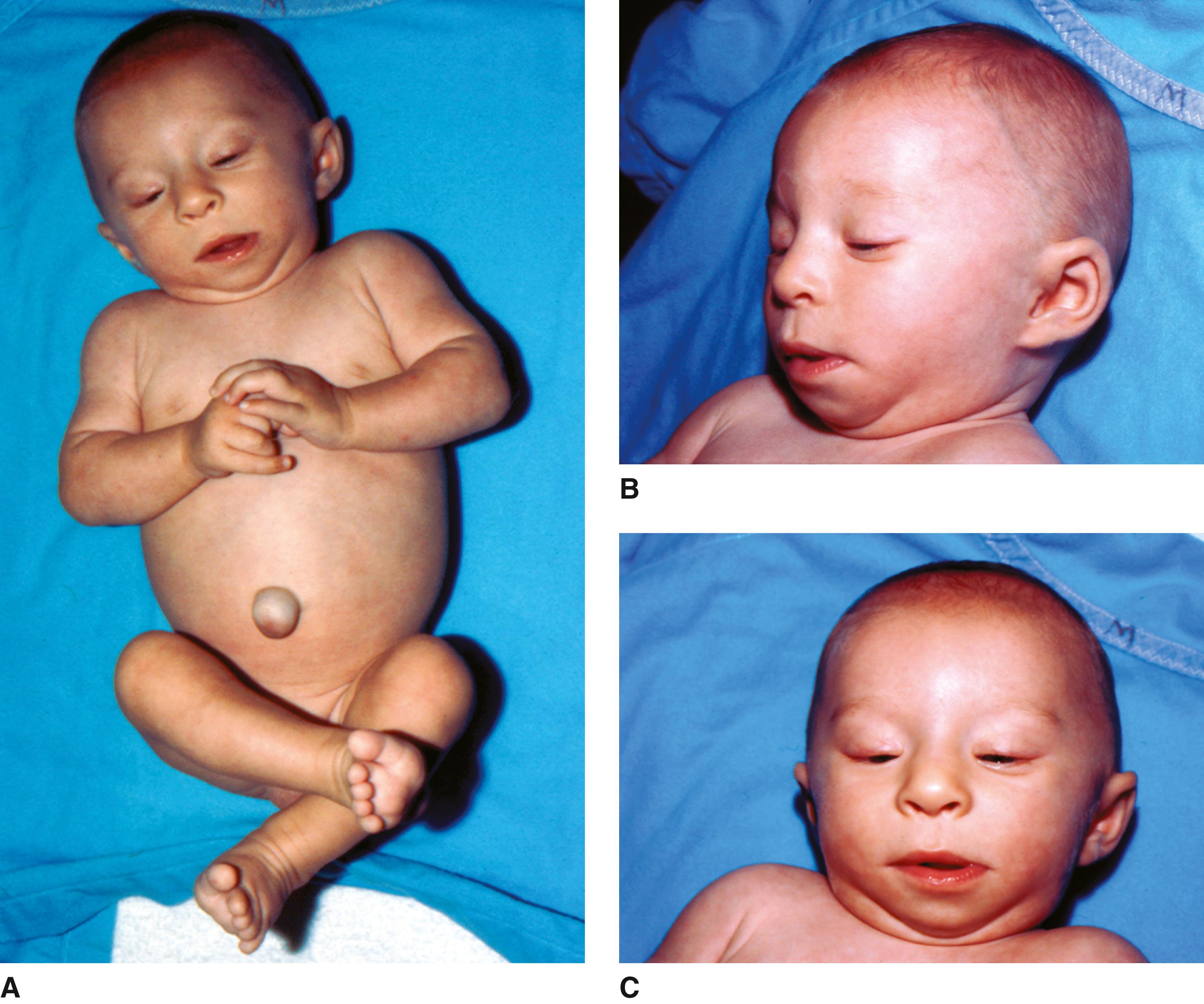 FIGURE 1, Deletion 3p syndrome.